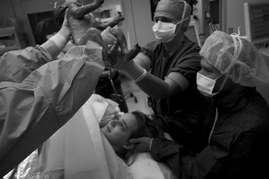 Keizersnee; easy way out? Baby uit buik keizersnee